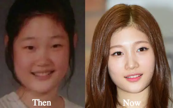 Plastic Surgery Trends k-pop k-dramas korean celebrities